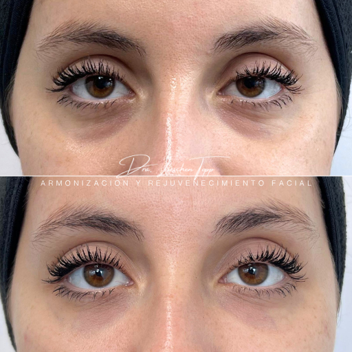 trartamiento ojeras